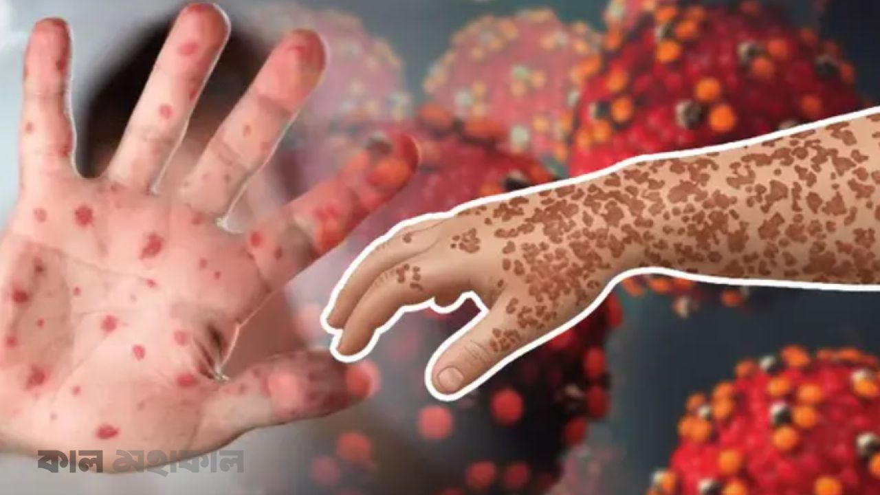 পাঁচ মাসে হাম ও উপসর্গে ৯০২ শিশুর মৃত্যু